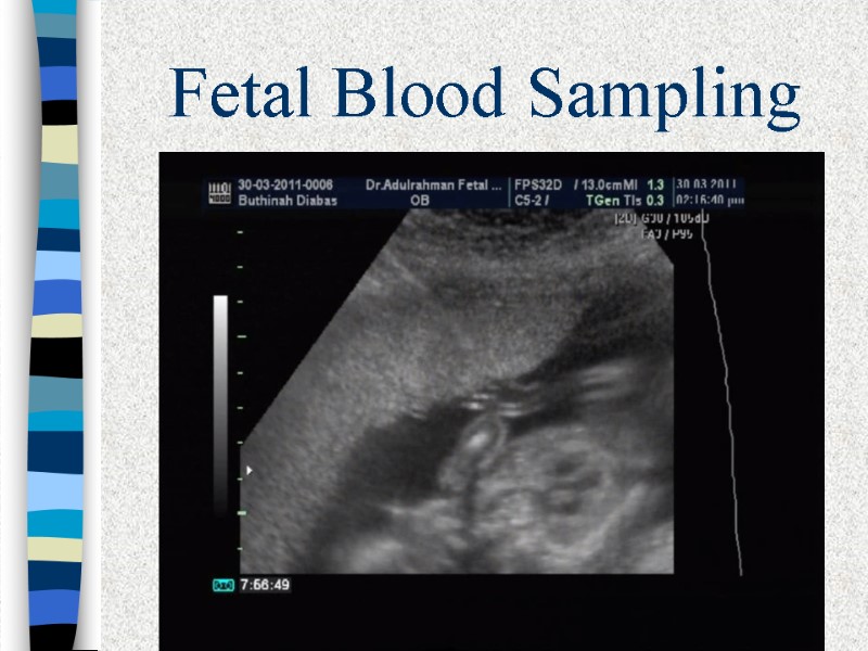 Fetal Blood Sampling